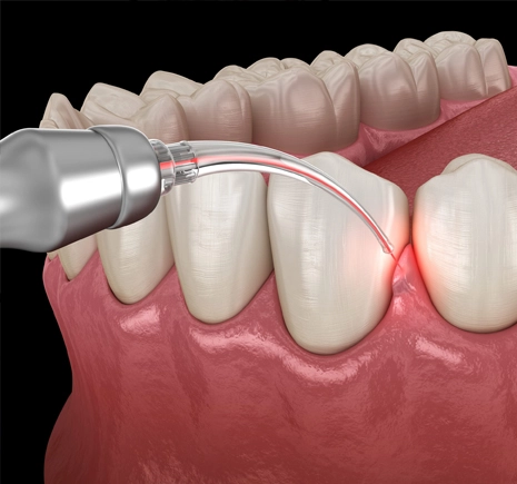 Periodontal Therapy and Gum Disease Treatment